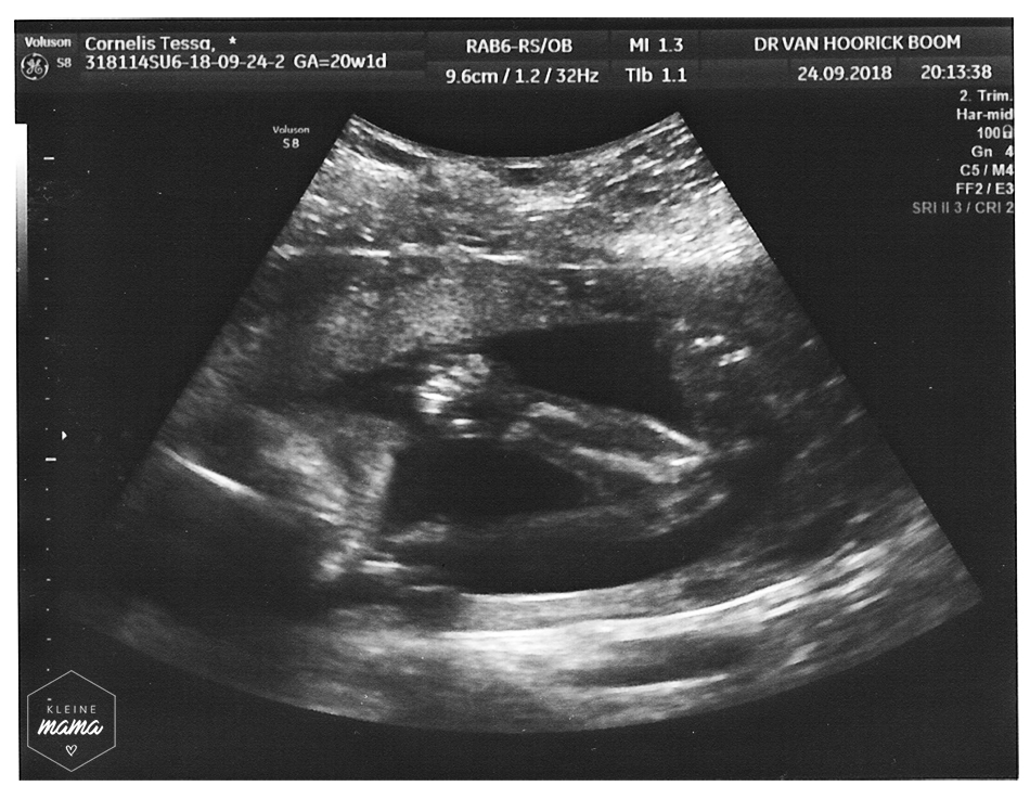 Echografie op twintig weken zwangerschap, gebogen arm met vingerkootjes te zien.